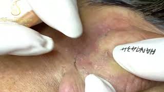 Loan Nguyen Acne Treatment 14411 [upl. by Stacey]