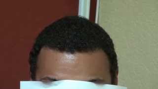 Dense Black Hair Transplant Hairline Restoration Result Bald Treatment Dr Diep wwwmhtacliniccom [upl. by Aibun]