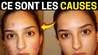 Quelles Sont les Causes des Boutons sur le Visage  Voir les 4 Principaux Facteurs [upl. by Nahtanod]