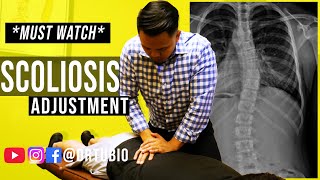 SEVERE SCOLIOSIS pain RELIEVED after Chiropractic Adjustments  Dr Alex Tubio [upl. by Aeduj]