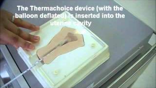 Demonstration on Endometrial ablation with Gynecare Thermachoice using a uterine model [upl. by Retniw493]