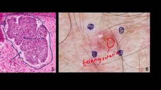 Introduction to NMSC Skin Cancer 2 Basal Cell Cancer BCC and Squamous Cell Cancer SCC [upl. by Oironoh]