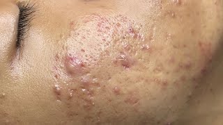 ACNE TREATMENT VU QUYNH MI  Perennial Blackheads On Boy Face 2024FULL [upl. by Ielirol331]