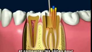 Le traitement de canal dentaire Clinique Dentaire Orozen [upl. by Orin]