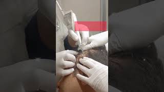 Seborrheic keratosis treatment  Laser Treat [upl. by Ephrayim513]