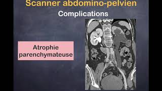 Lithiase Urinaire  4 Complications [upl. by Ynaffad]