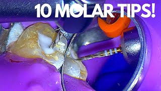 Top 10 Molar Root Canal Tips To Make Life Easier [upl. by Kaz941]