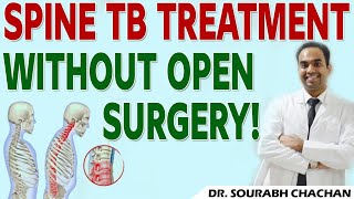 Spine TB Treatment Without Open Surgery  Dr Sourabh Chachan [upl. by Ilohcin118]