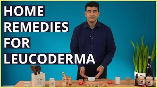 3 Best LEUCODERMA VITILIGO Treatments At Home With Natural Remedies [upl. by Ced]