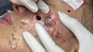 Big Cystic Acne Blackheads Extraction Blackheads amp Milia Whiteheads Removal Pimple Popping 11 [upl. by Armando]