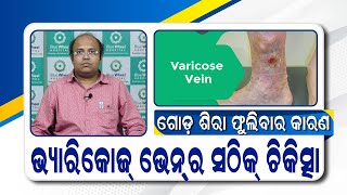 Varicose Veins  କରନ୍ତୁ ସଠିକ୍ ଚିକିତ୍ସା  Best Treatment of Varicose Veins in Odia  Dr Deepak Das [upl. by Nitza]