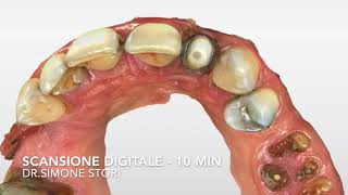 Dente Nuovo in 2 ore Ecco come recuperare un dente con la Protesi Digitale Immediata a Bologna [upl. by Yreffej]