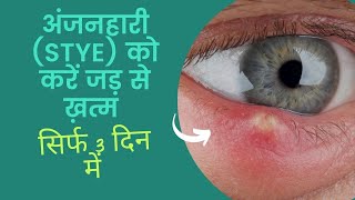 अंजनहारी गुहेरी को करें जड़ से ख़त्म II STYE Allopathic Treatment amp Home Remedies। [upl. by Ribaj]