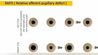 Relative afferent pupillary defect  RAPD  explained [upl. by Jeunesse100]