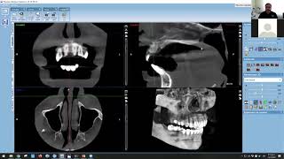 32CURSO DE ROMEXIS VIEWER 2da Parte [upl. by Kcod]