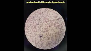 Hematologyanaemiamicrocytic hypochromicpathologymedical [upl. by Eyks]