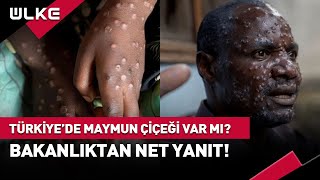 Türkiyede Maymun Çiçeği Virüsü Görüldü Mü Bakanlıktan Net Yanıt haber [upl. by Eart344]