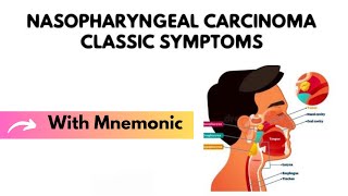 Nasopharyngeal Carcinoma Classic Symptoms With Mnemonic  ENT Mnemonics  Dr Mubashar Ata [upl. by Hallimaj]