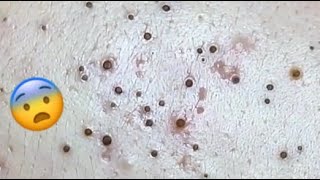 WHAT DO YOU THINK ABOUT THESE BLACKHEADS HOW WILL HE REMOVE IT 😨 relaxing blackheads [upl. by Penland]