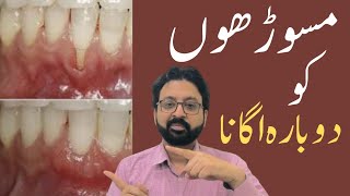 How to Rebuild Gums to Cure Gum Recession [upl. by Cowen]