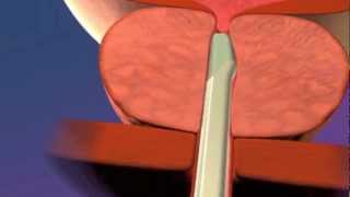 The UroLift System Animation [upl. by Aneel909]