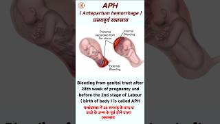 Antepartum hemorrhage in hindi  APH in pregnancy  cause of aph [upl. by Plunkett313]