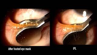 Meibomian gland expression differences with and without IPL [upl. by Yerffoj806]