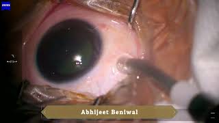 Intravitreal chemotherapy for retinoblastoma [upl. by Thilda487]