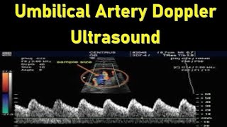 Umbilical Artery Doppler Ultrasound Interpretation  Doppler Ultrasound in Fetal Growth Assessment [upl. by Emelda290]