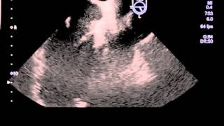 Infective Endocarditis of Aortic Valve Transesophageal Ecocardogram [upl. by Neiluj]