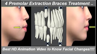 Changes in Face After 4 1st Premolars Extraction amp Braces Treatment Best HD Animation  Dr Ram MDS [upl. by Yolande]