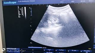 ureteric jet and bilateral hudroureteronephrosis ē dilated loaded rectum [upl. by Eniarral]