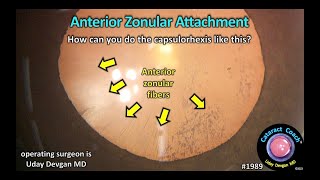 CataractCoach™ 1989 anterior zonular attachment on the lens capsule [upl. by Hauck]