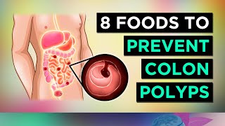 8 Foods To Prevent COLON POLYPS amp BOWEL CANCER [upl. by Niwrehs]