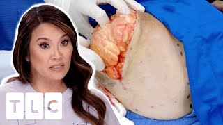 Dr Lee Removes HUGE Lipoma From Patients Shoulder  Dr Pimple Popper Pop Ups [upl. by Haduj]