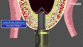 OSSTEM  HIOSSEN CASKit Crestal Approach Sinus Kit [upl. by Rednave]