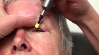 Blepharitis Treatment That Really Works Blephex Eyelid Cleaning [upl. by Eserahs]