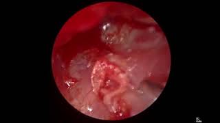 Endoscopic quotClip myringoplastyquot [upl. by Nilad]