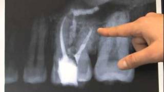 Endodontic Case  Found Calcium Hydroxide [upl. by Lehcyar]