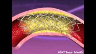 Heartistry Stent Implant Animation [upl. by Pieter]