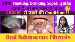 Osmf treatment in hindi Oral submucous fibrosis cause and treatment Dr Kanchan Singh [upl. by Rednasyl]