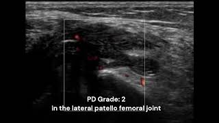 PD ultrasonography and CPSP after TKA  Supplementary video ID 403641 [upl. by Biernat]