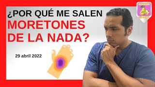 🔴Te interesa🔴 CONOCE las 7️⃣ CAUSAS por las que te salen MORETONES 🟣 [upl. by Swart]