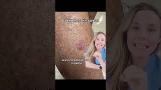 Would you recognized this common skin cancer skincancer dermatologist [upl. by Nimref]