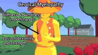 Cervical Myelopathy [upl. by Nalehp]