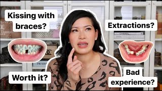 Adult Braces 2 year Journey Kissing with braces QampA Price Pros Cons Worth it  kimcurated [upl. by Arutnev]