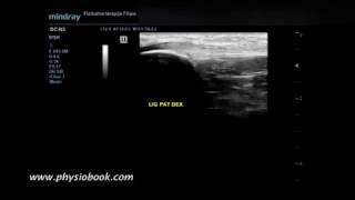 Jumpers knee  MSK ultrasound [upl. by Shelburne721]