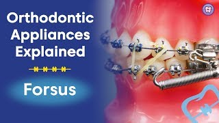 Orthodontic Appliances Explained  Forsus [upl. by Reisfield]