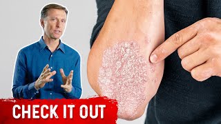 A Great Psoriasis Remedy [upl. by Slayton]