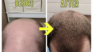 CRAZY MICRONEEDLING RESULTS TO STOP BALDING AND HAIR LOSS [upl. by Woodrow]